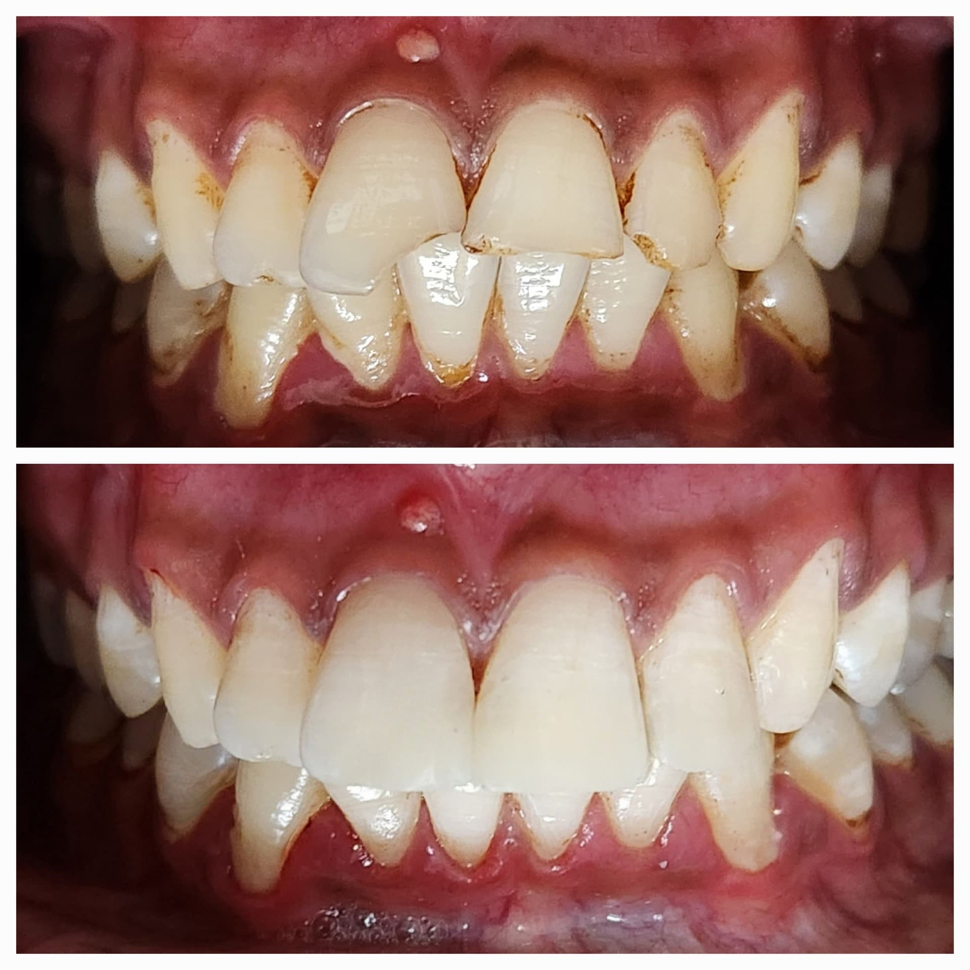 Front tooth repair