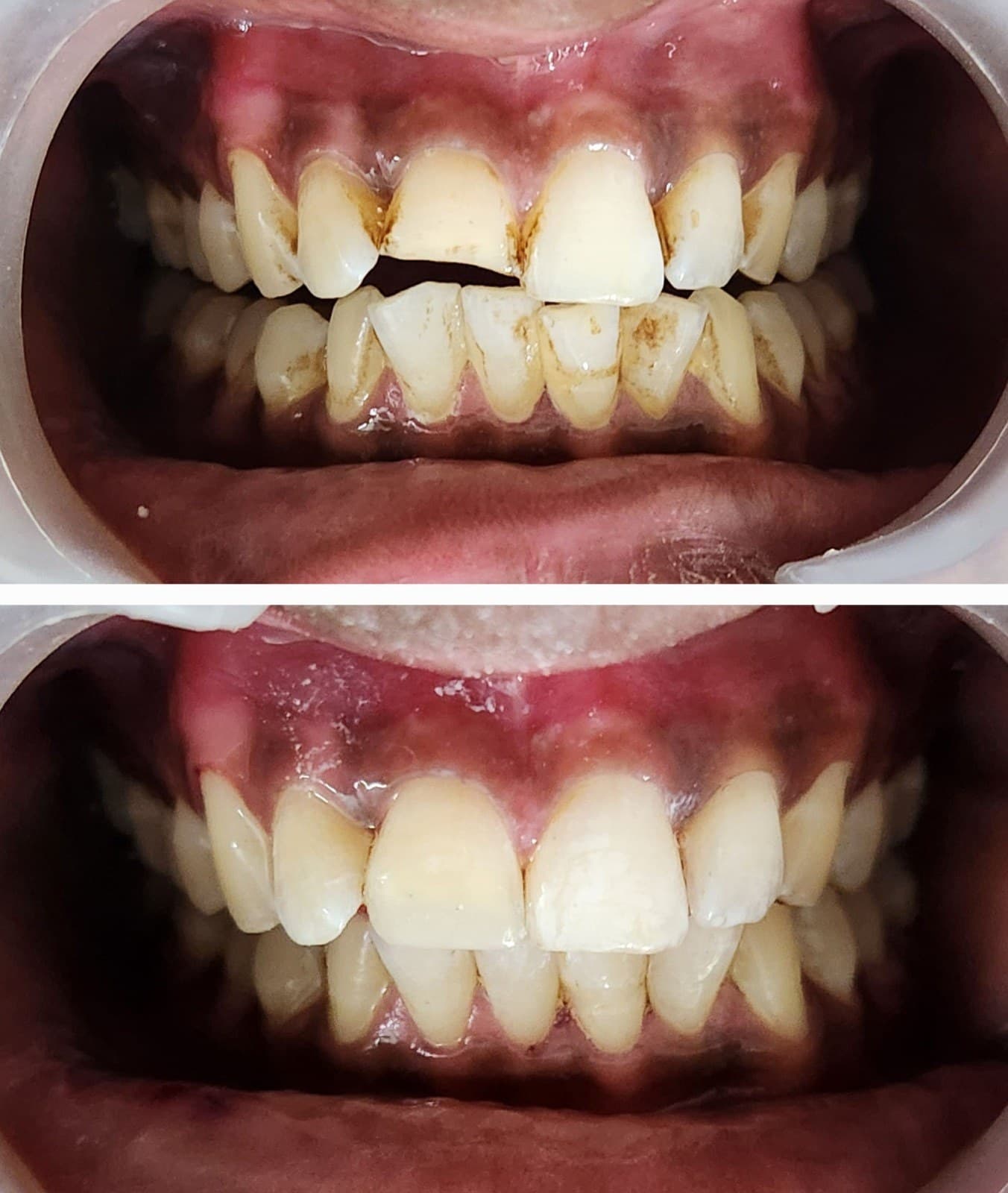 Front tooth repair
