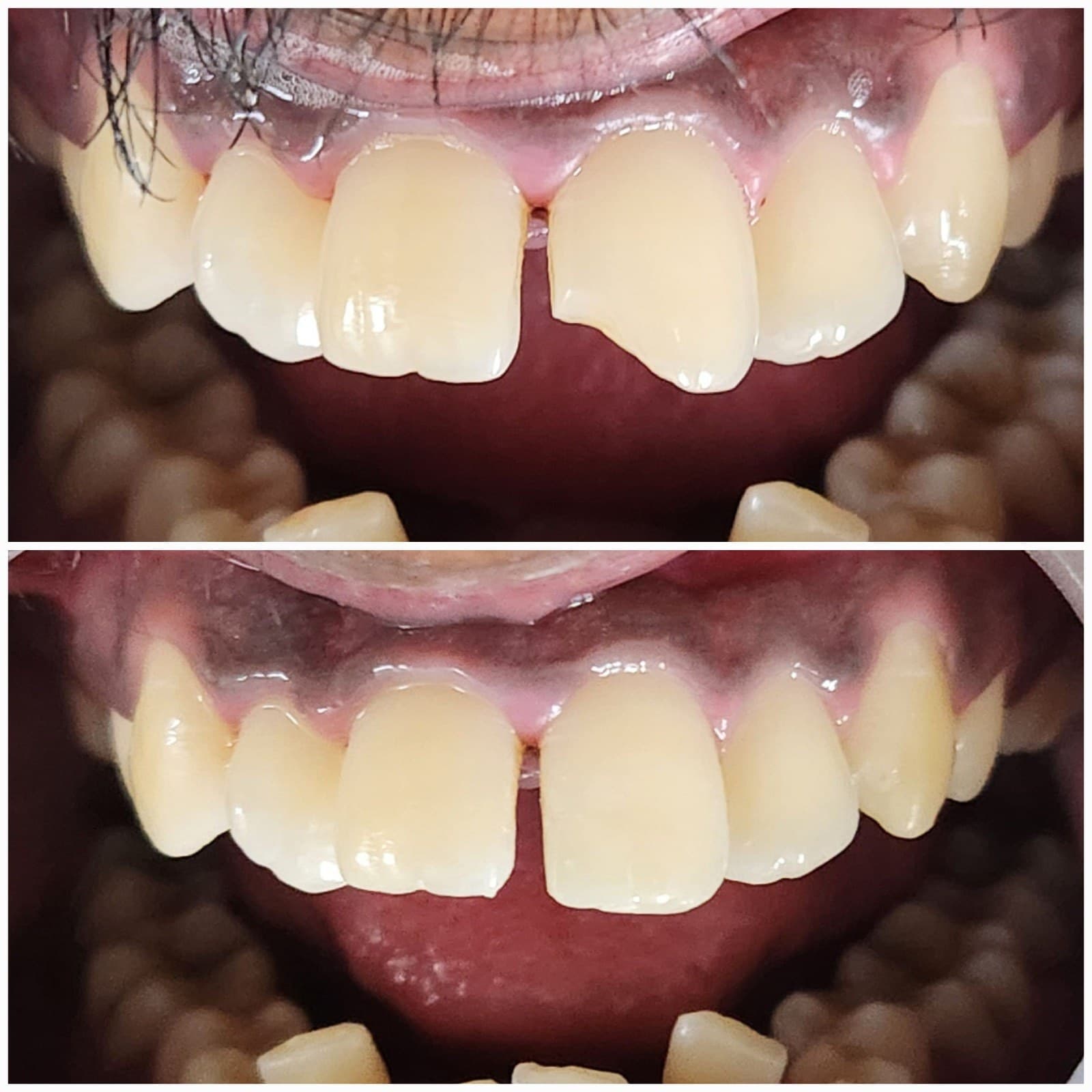 Front tooth repair