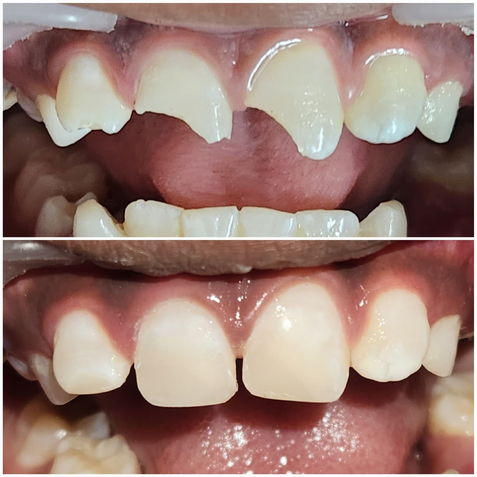 Front tooth repair