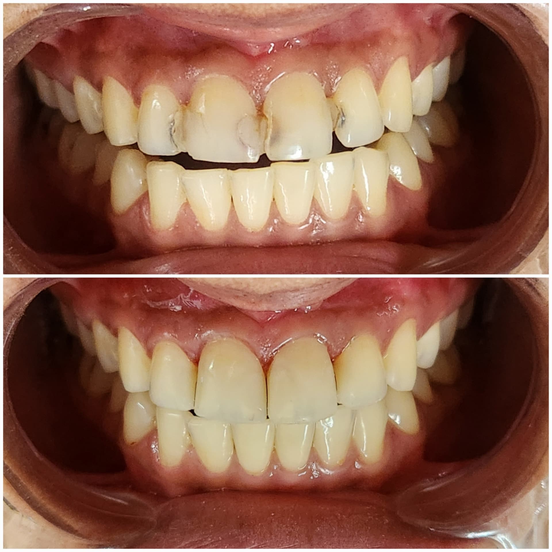Front tooth repair