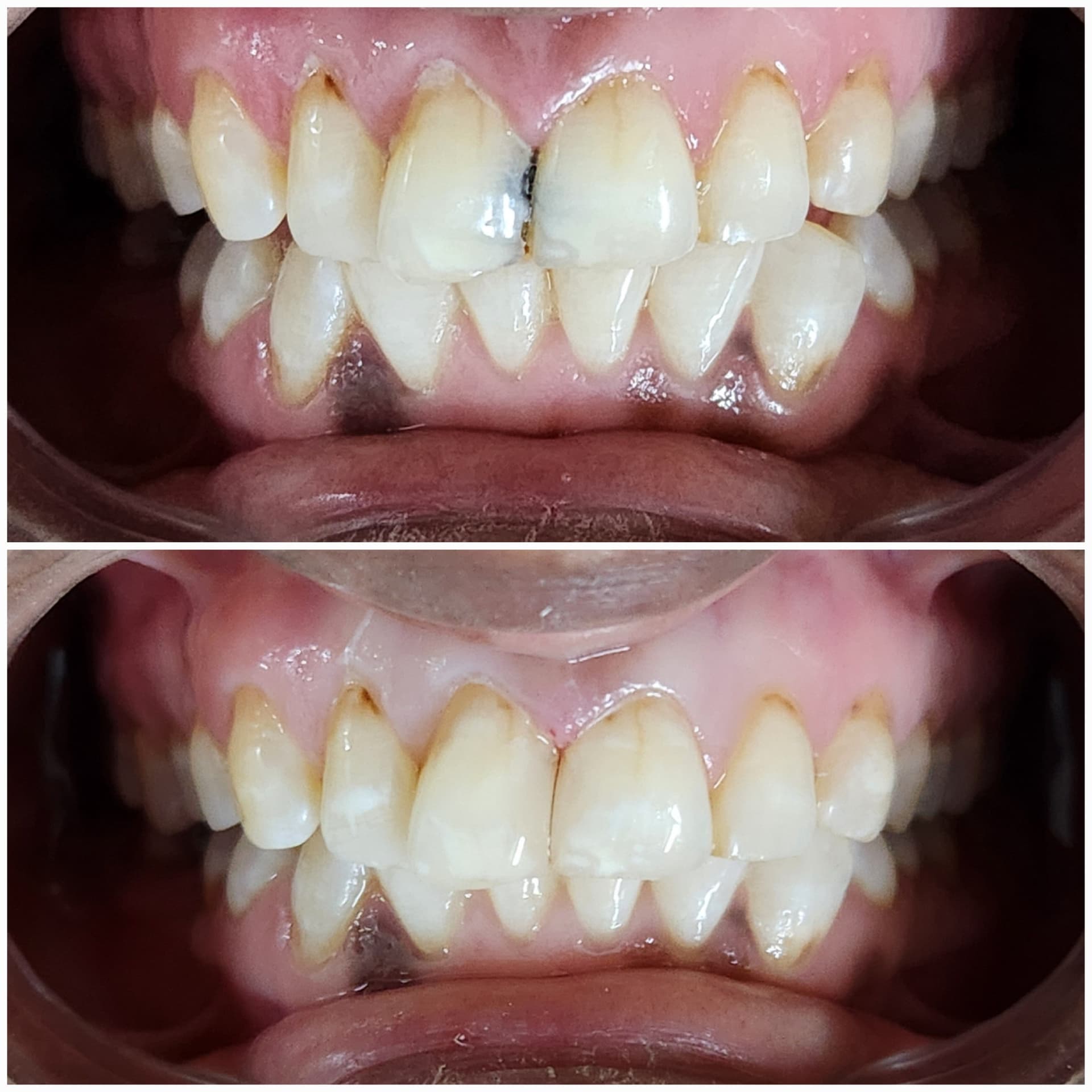 Front tooth repair