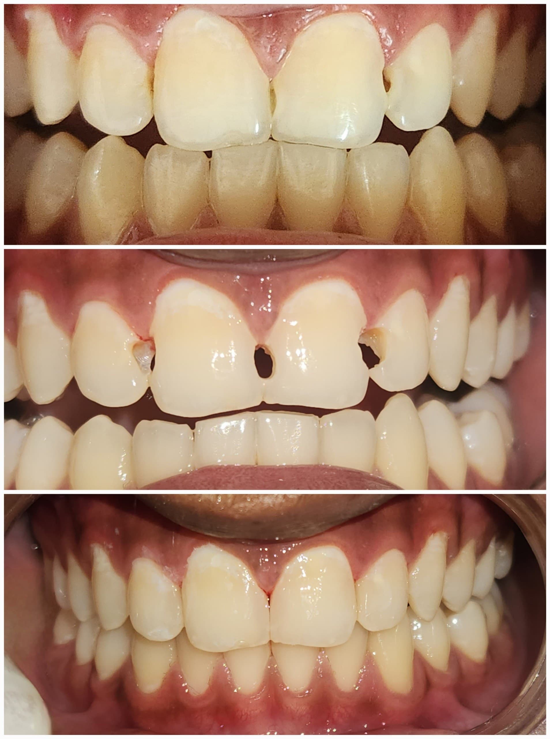 Front tooth repair