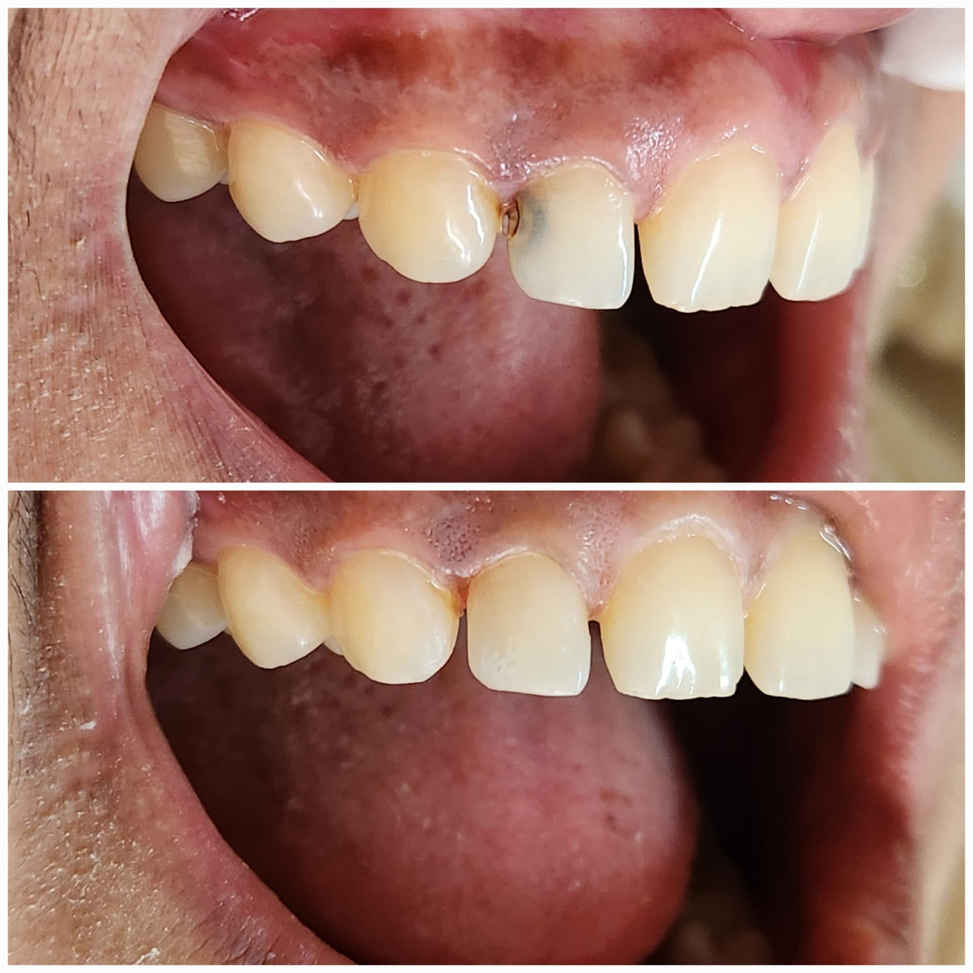 Front tooth repair