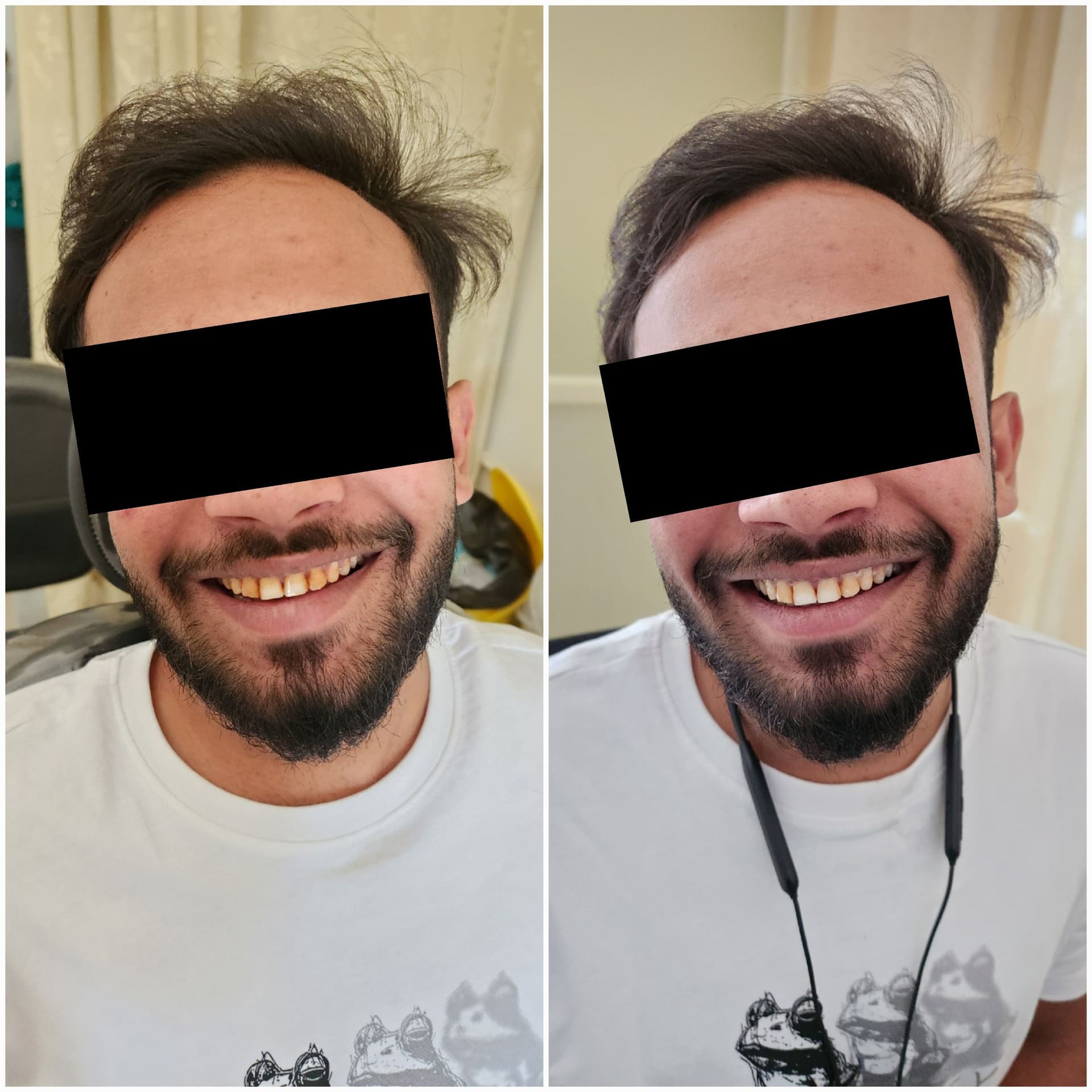 Teeth whitening