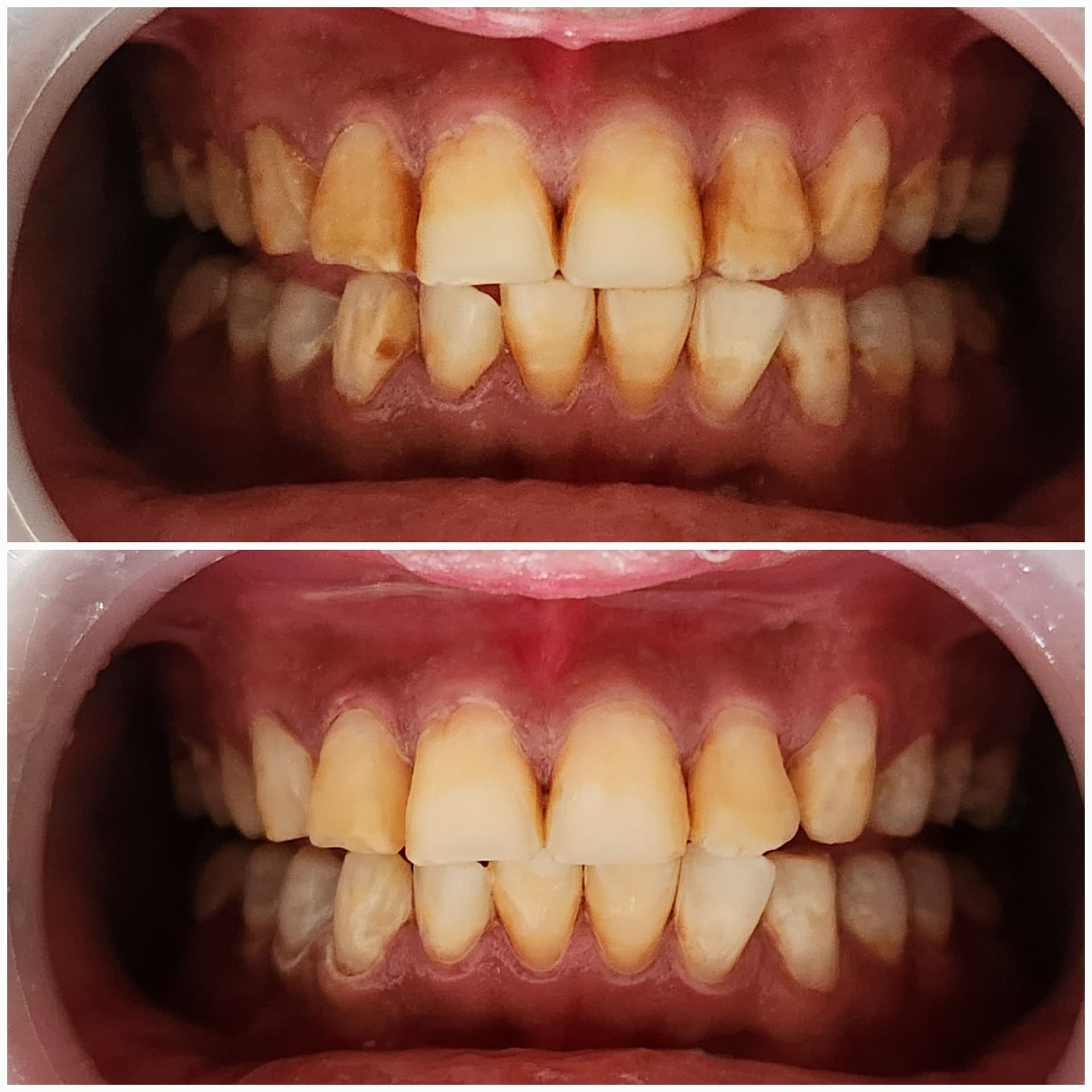Teeth whitening
