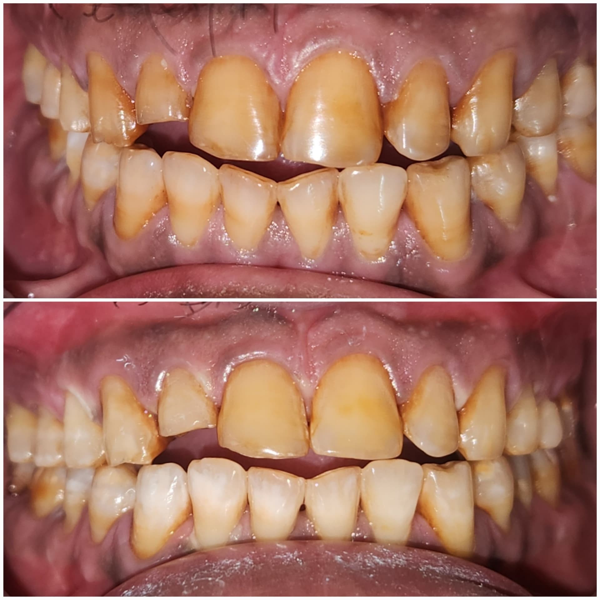 Teeth whitening