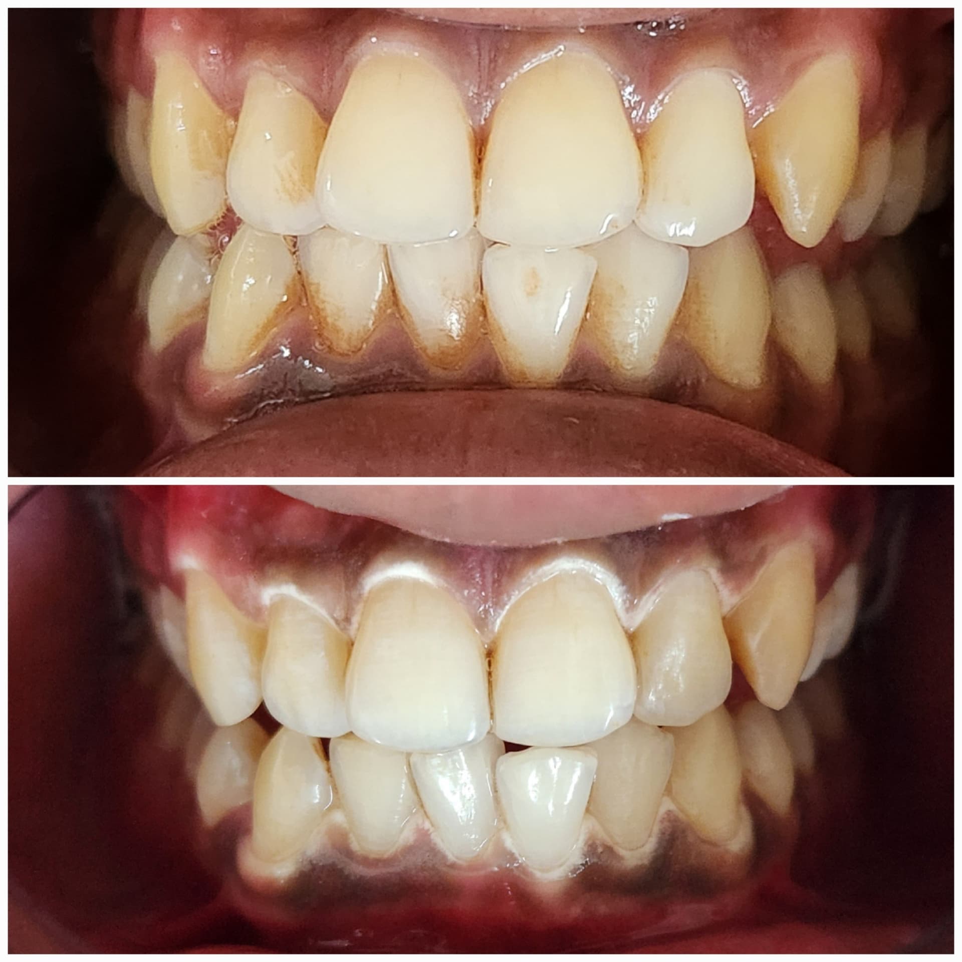 Teeth whitening