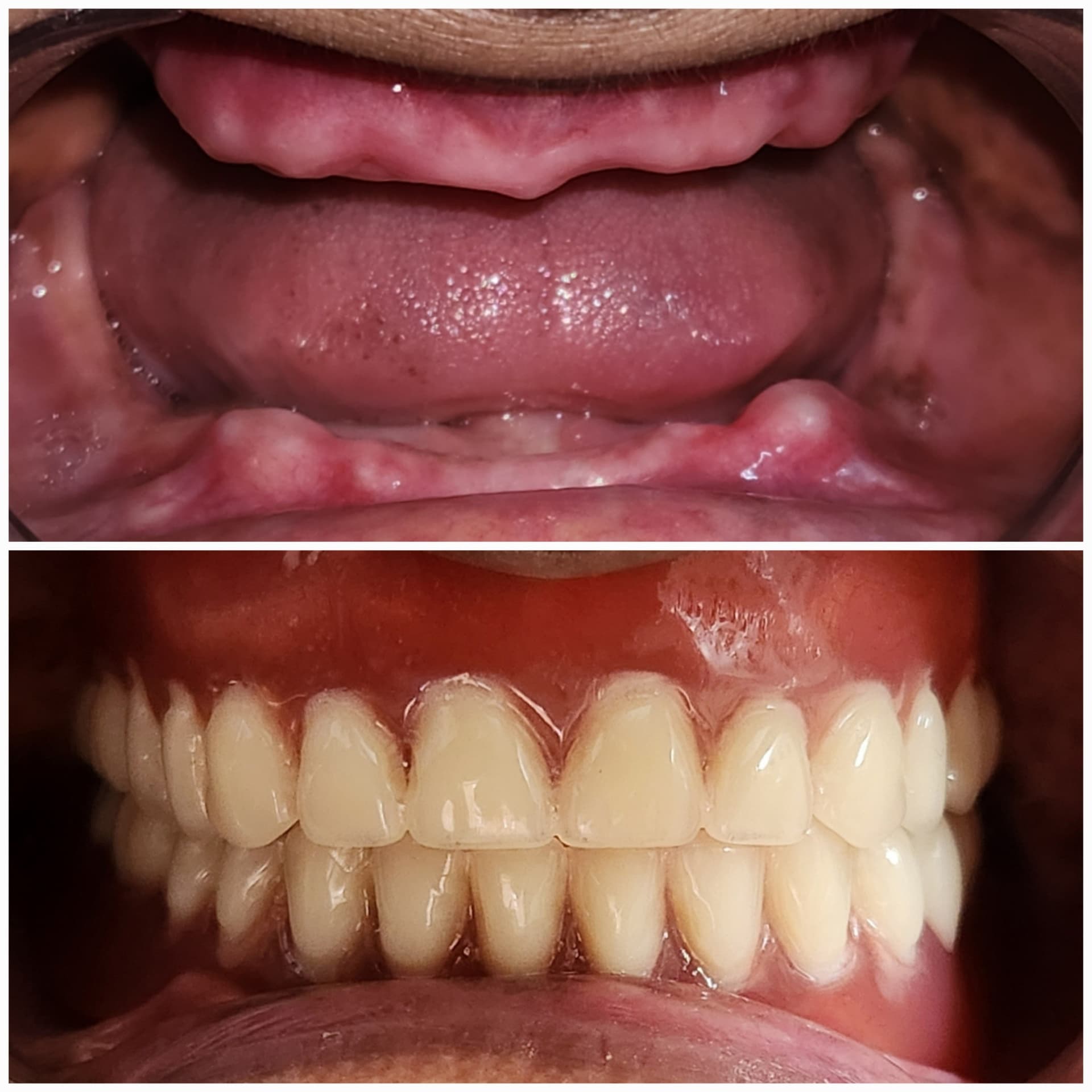 Complete denture