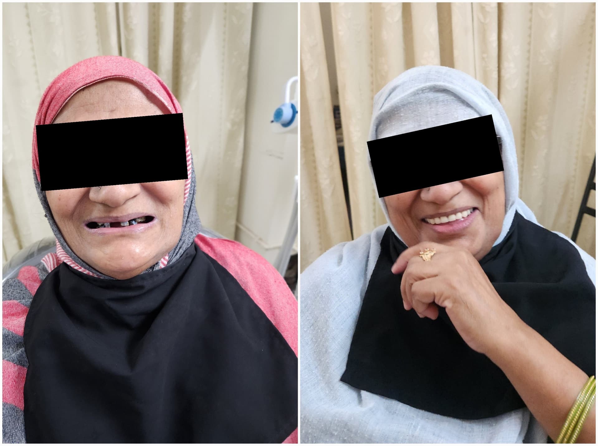 Complete denture