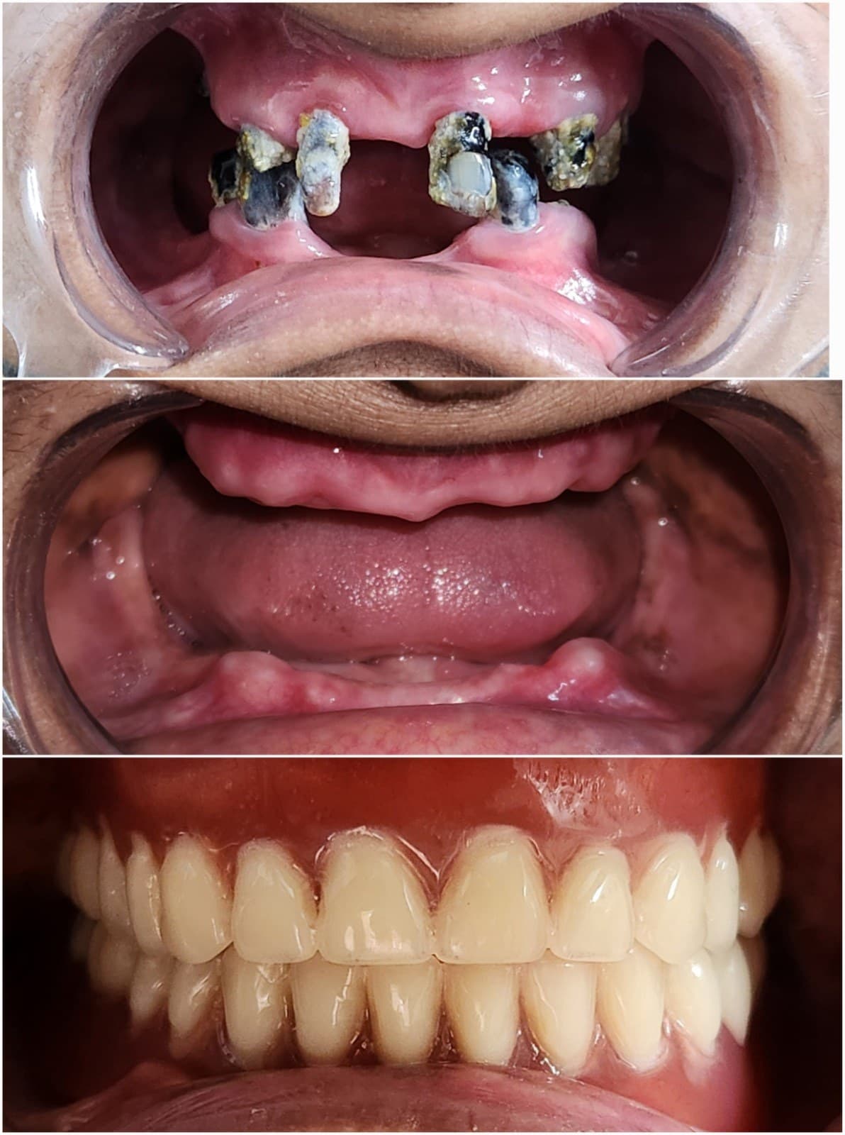 Complete denture
