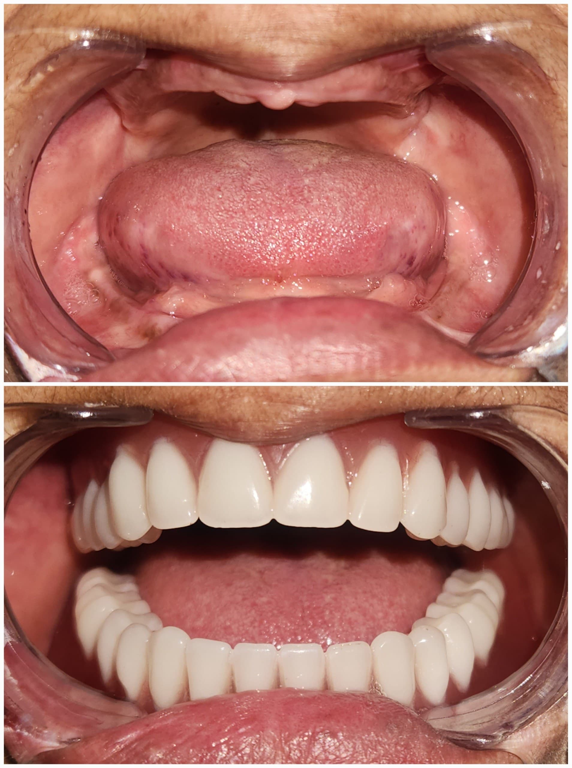 Complete denture