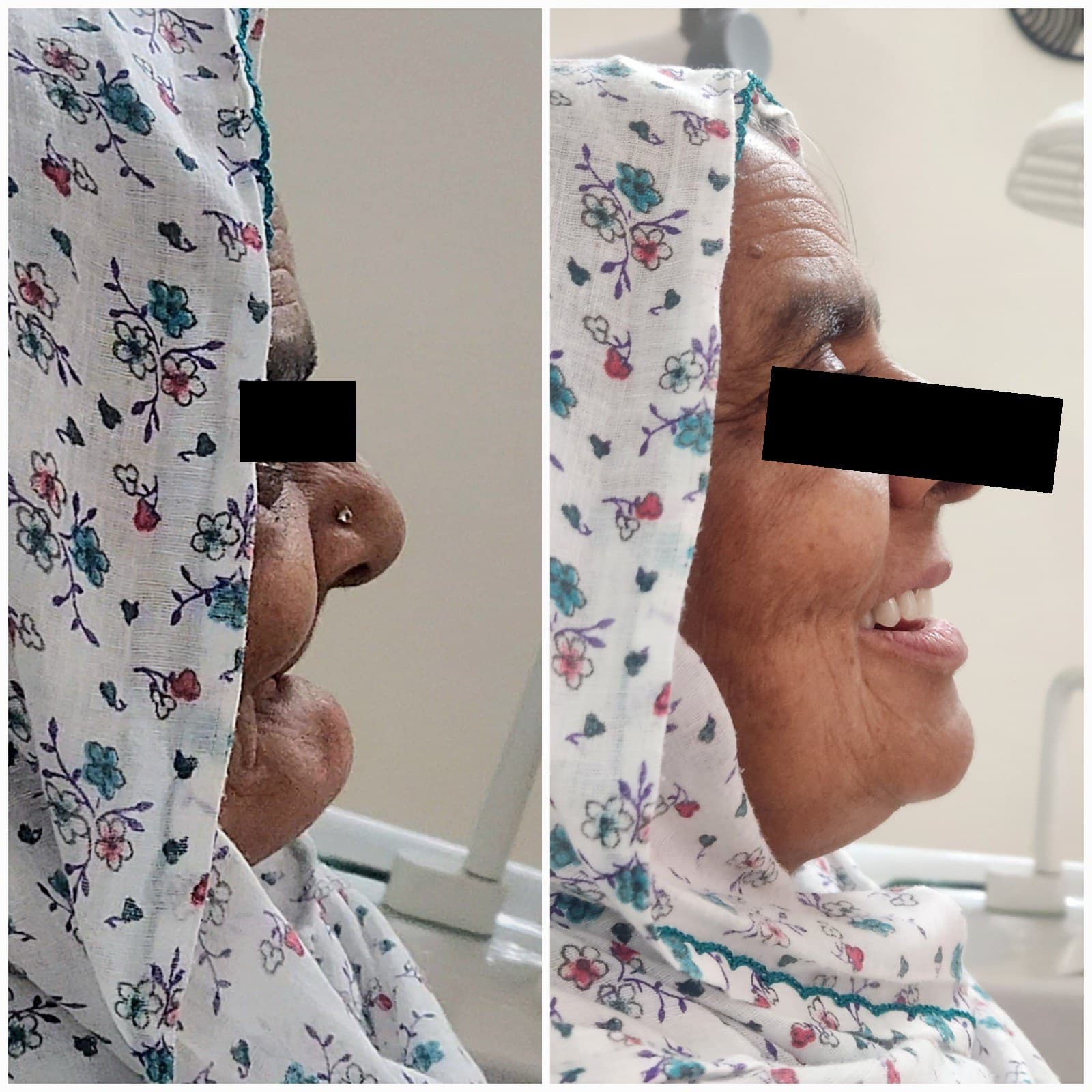 Complete denture