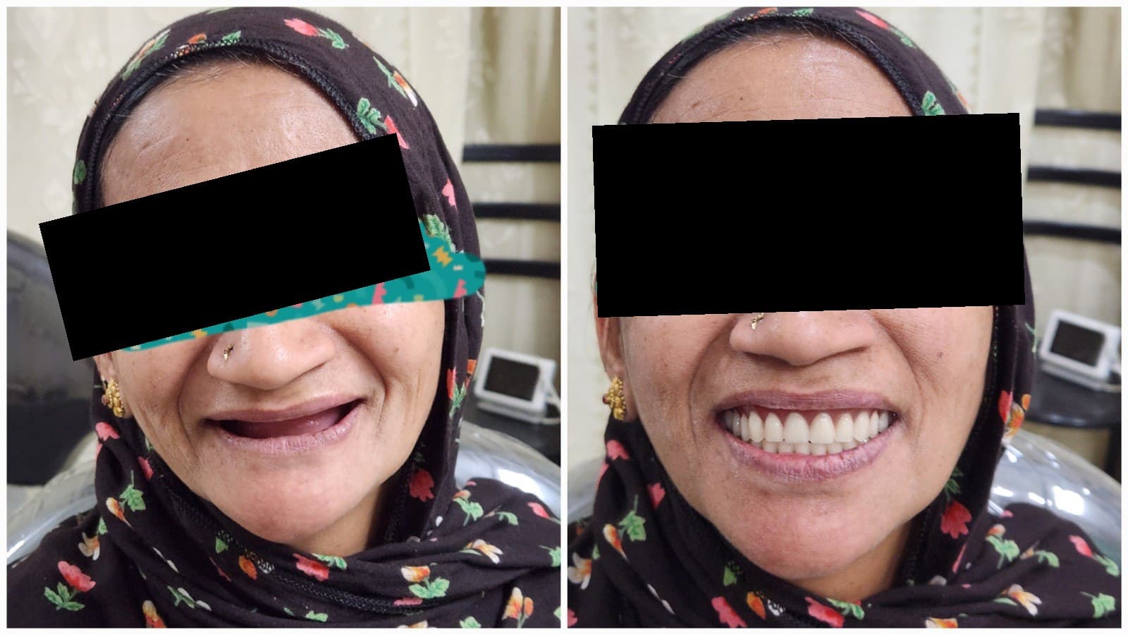 Complete denture
