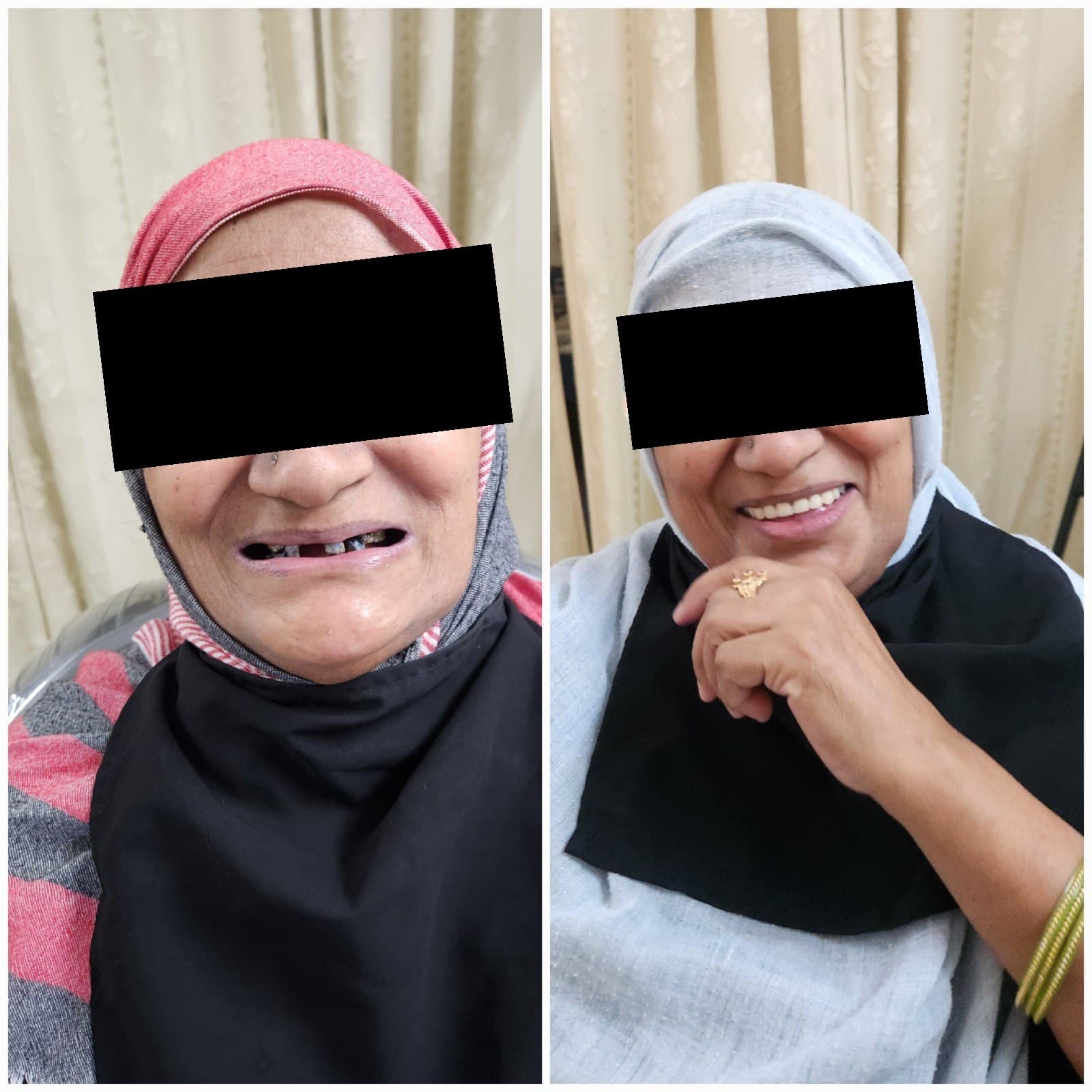 Complete denture
