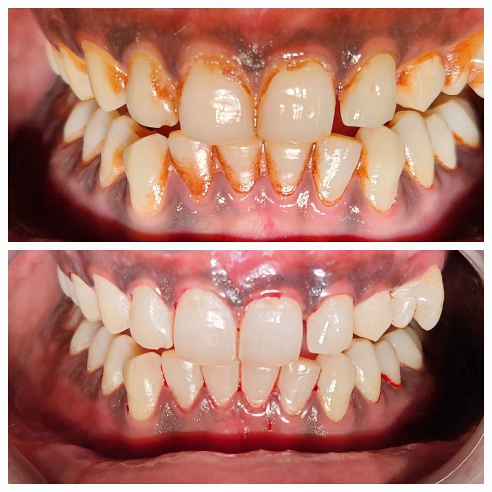 Scaling & cleaning