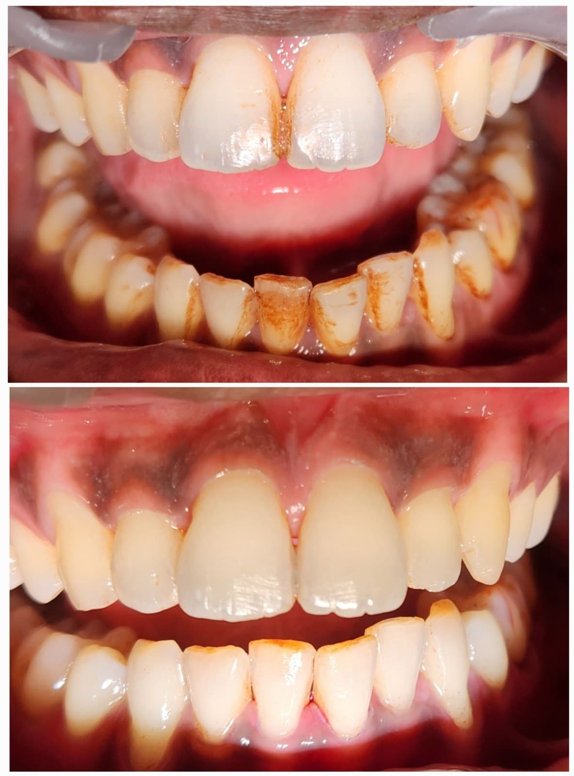 Scaling & cleaning