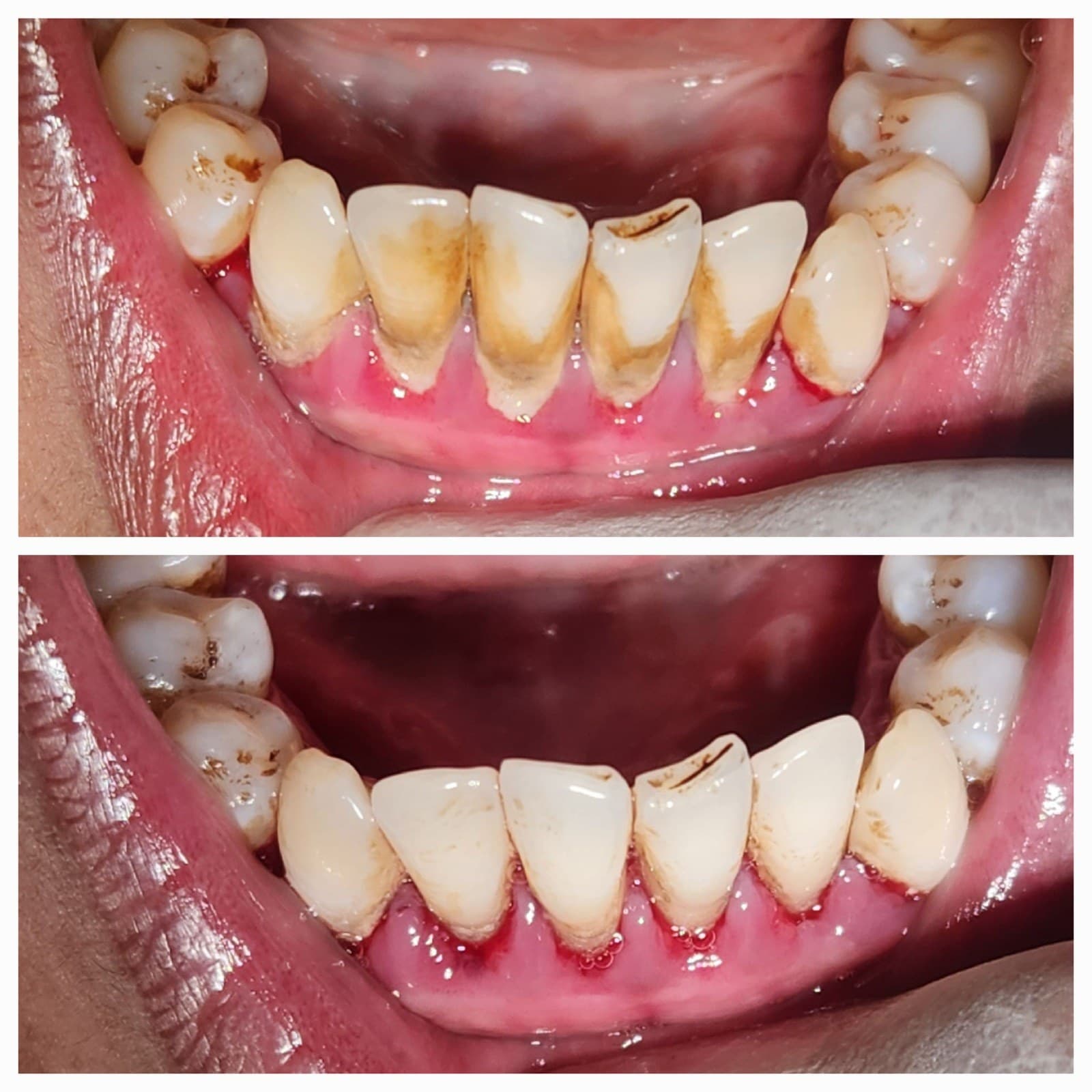 Scaling & cleaning