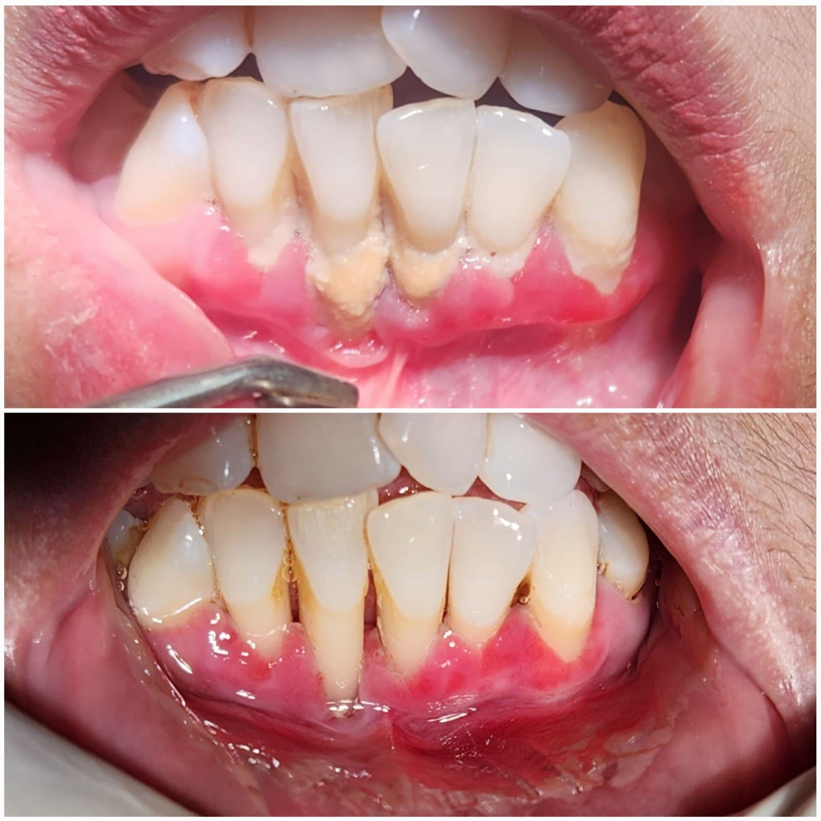 Scaling & cleaning