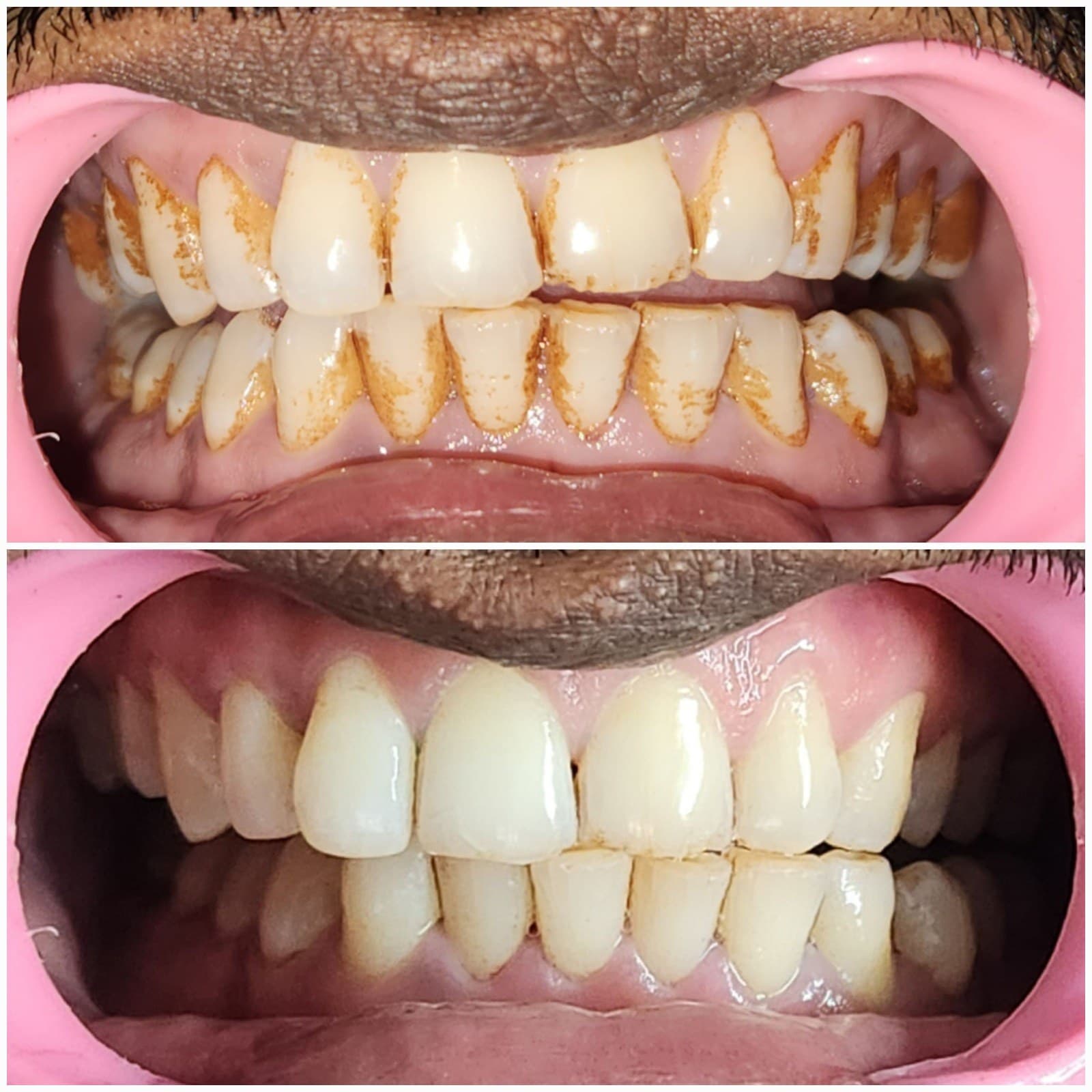Scaling & cleaning
