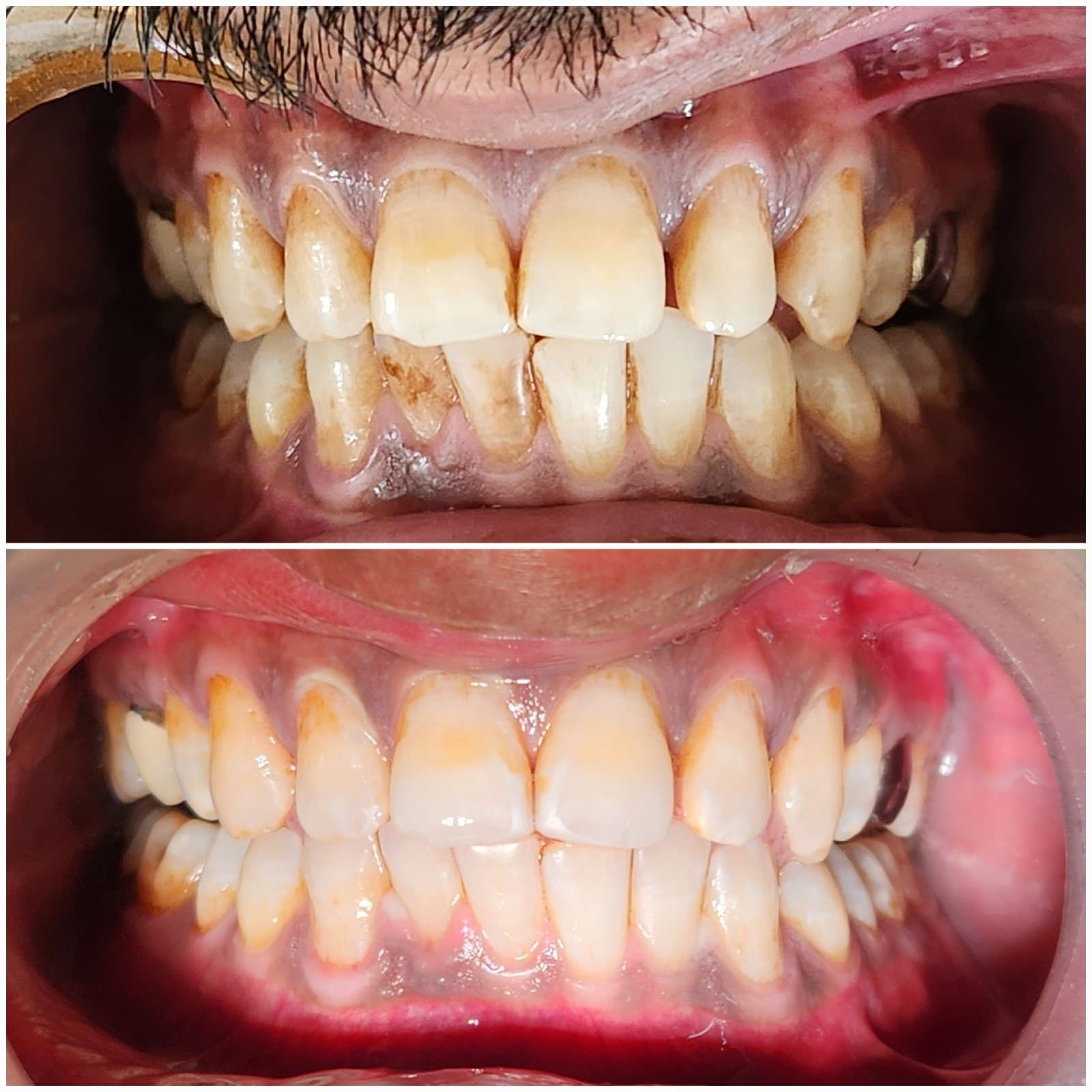 Scaling & cleaning