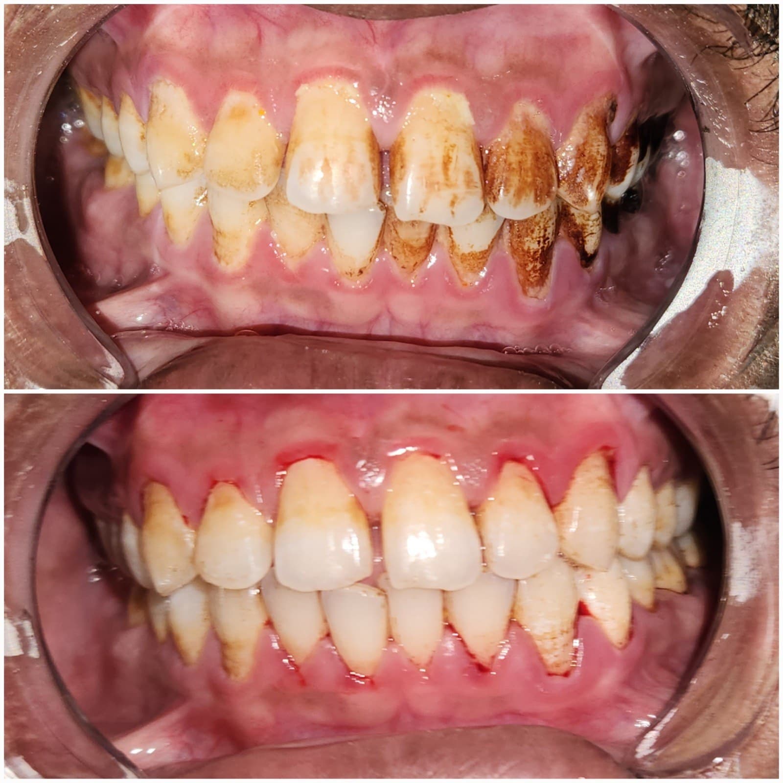 Scaling & cleaning
