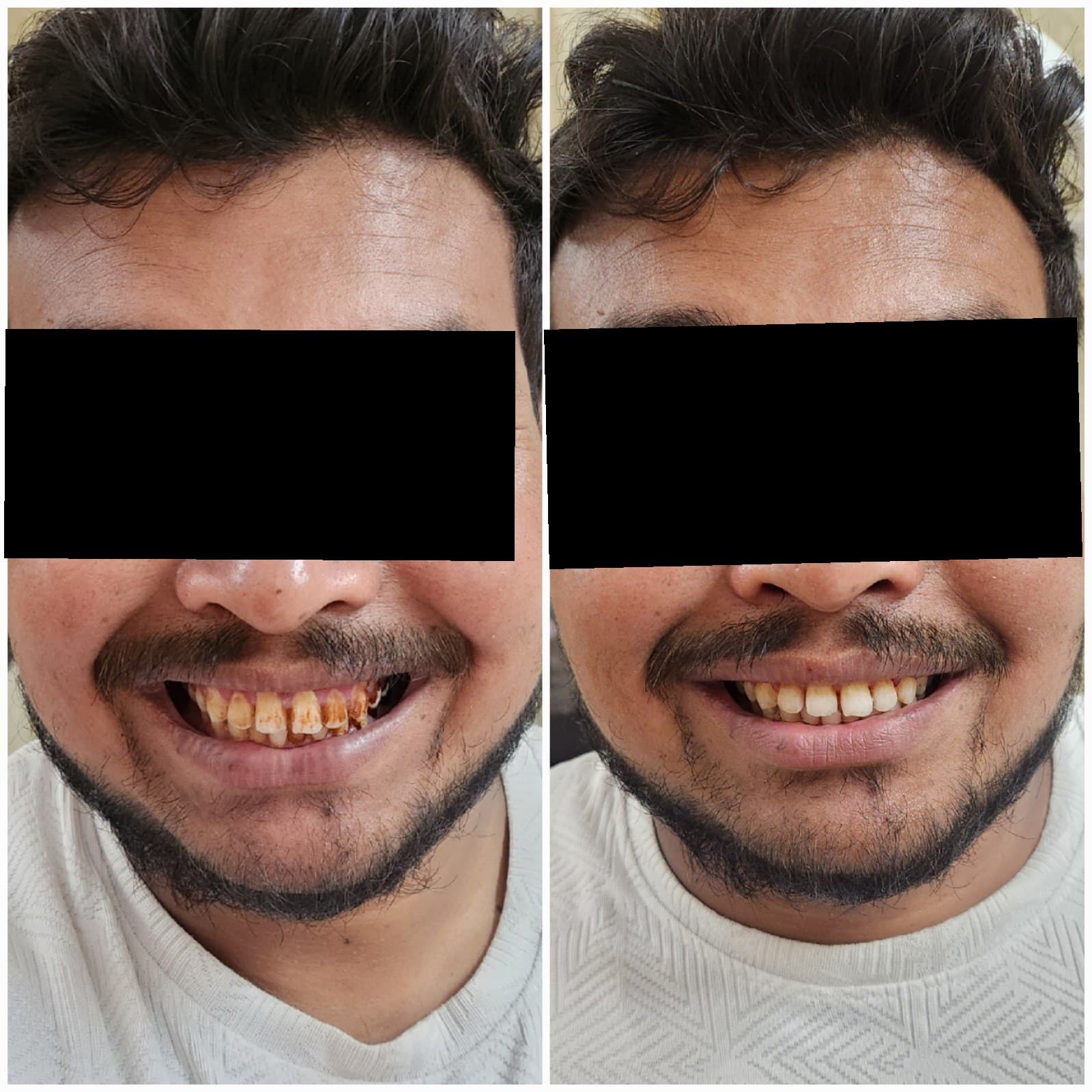 Scaling & cleaning