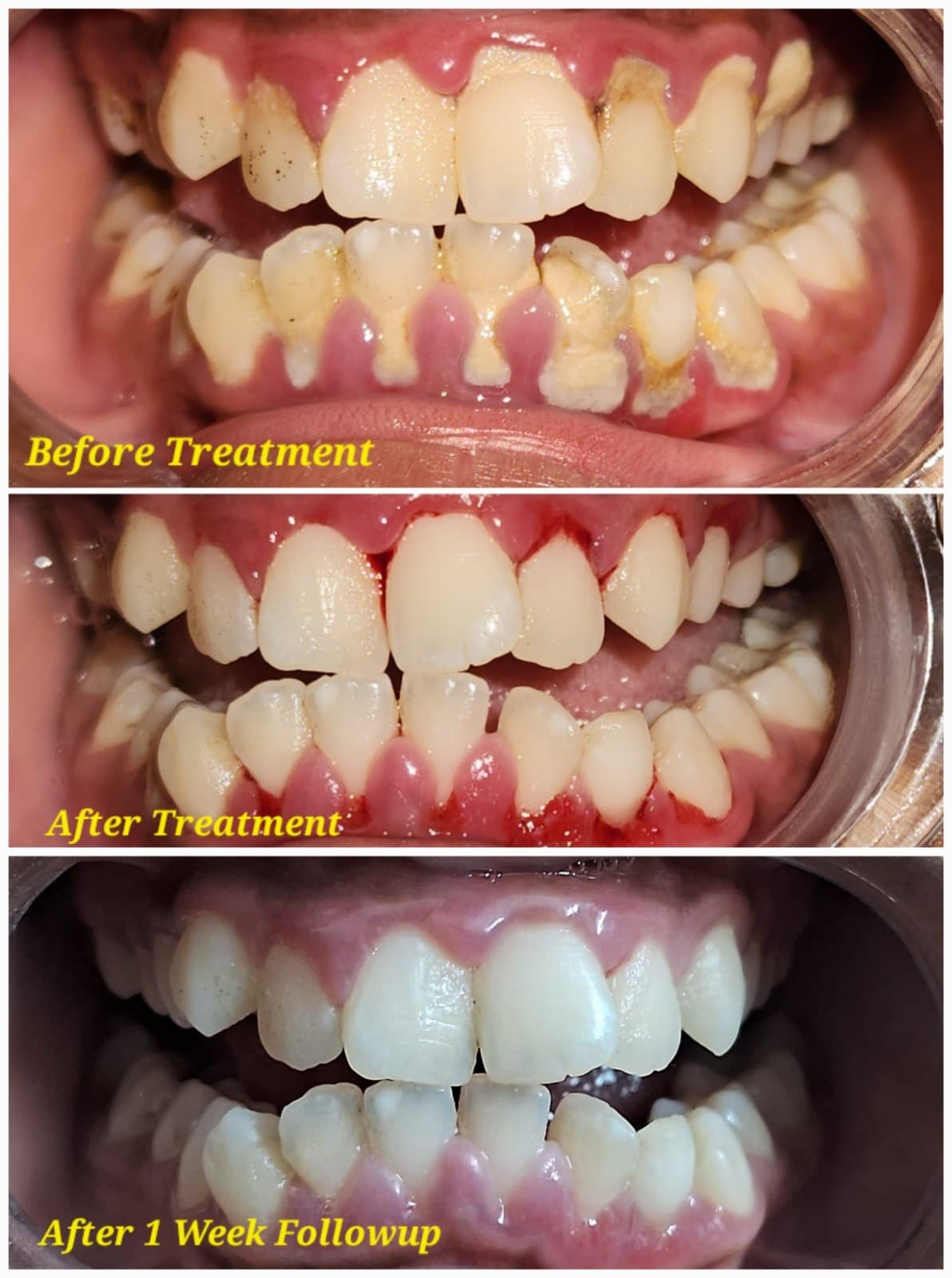 Scaling & cleaning