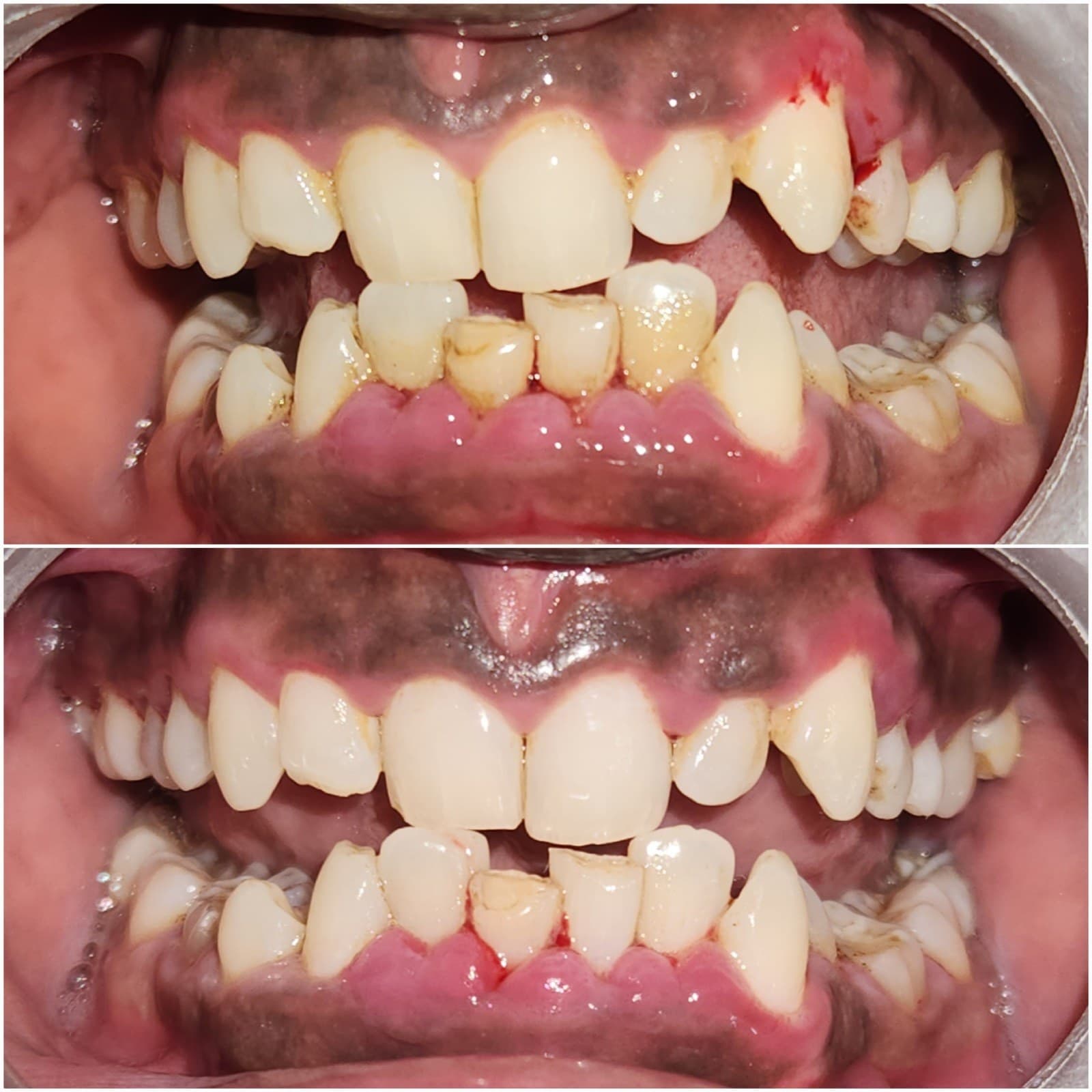 Scaling & cleaning