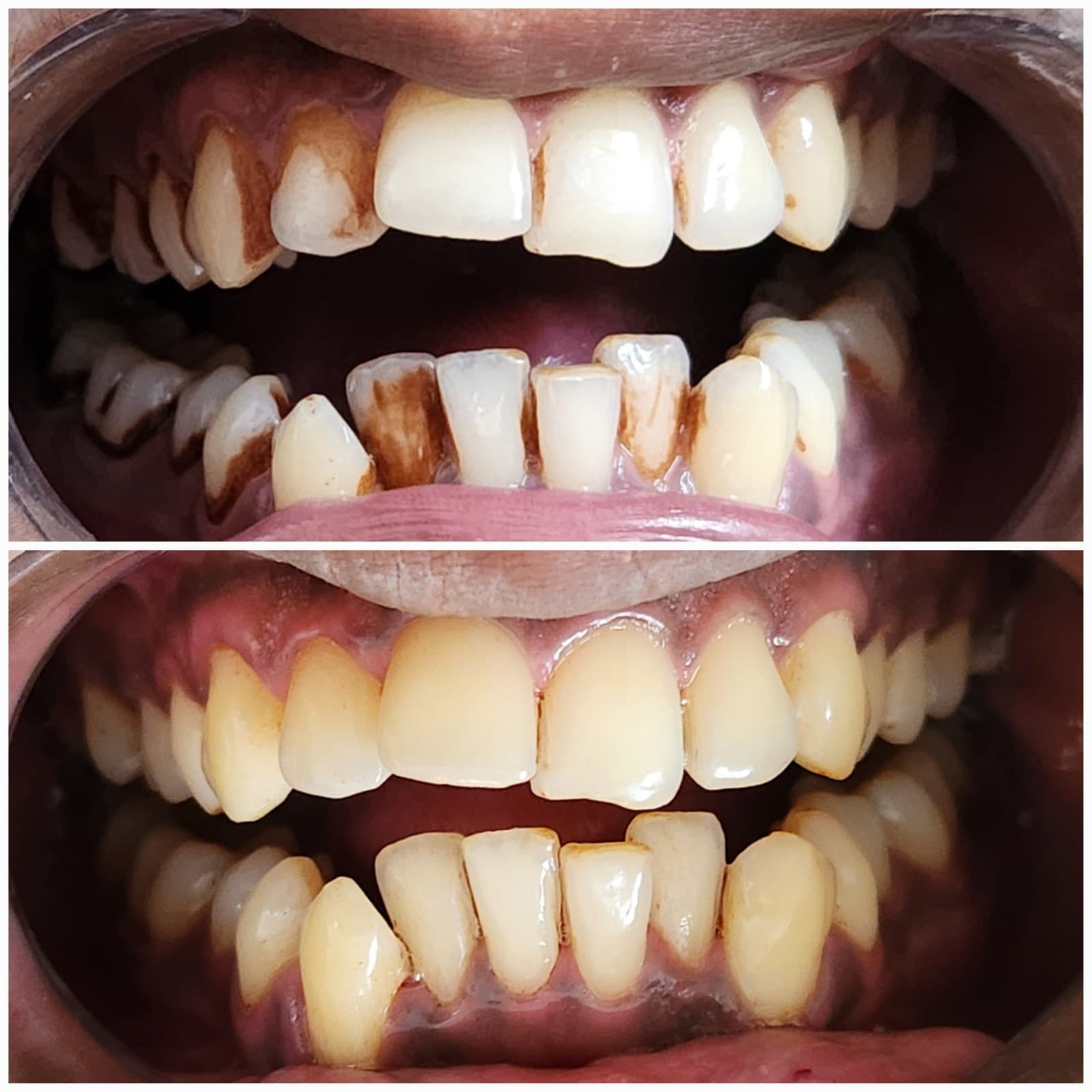 Scaling & cleaning