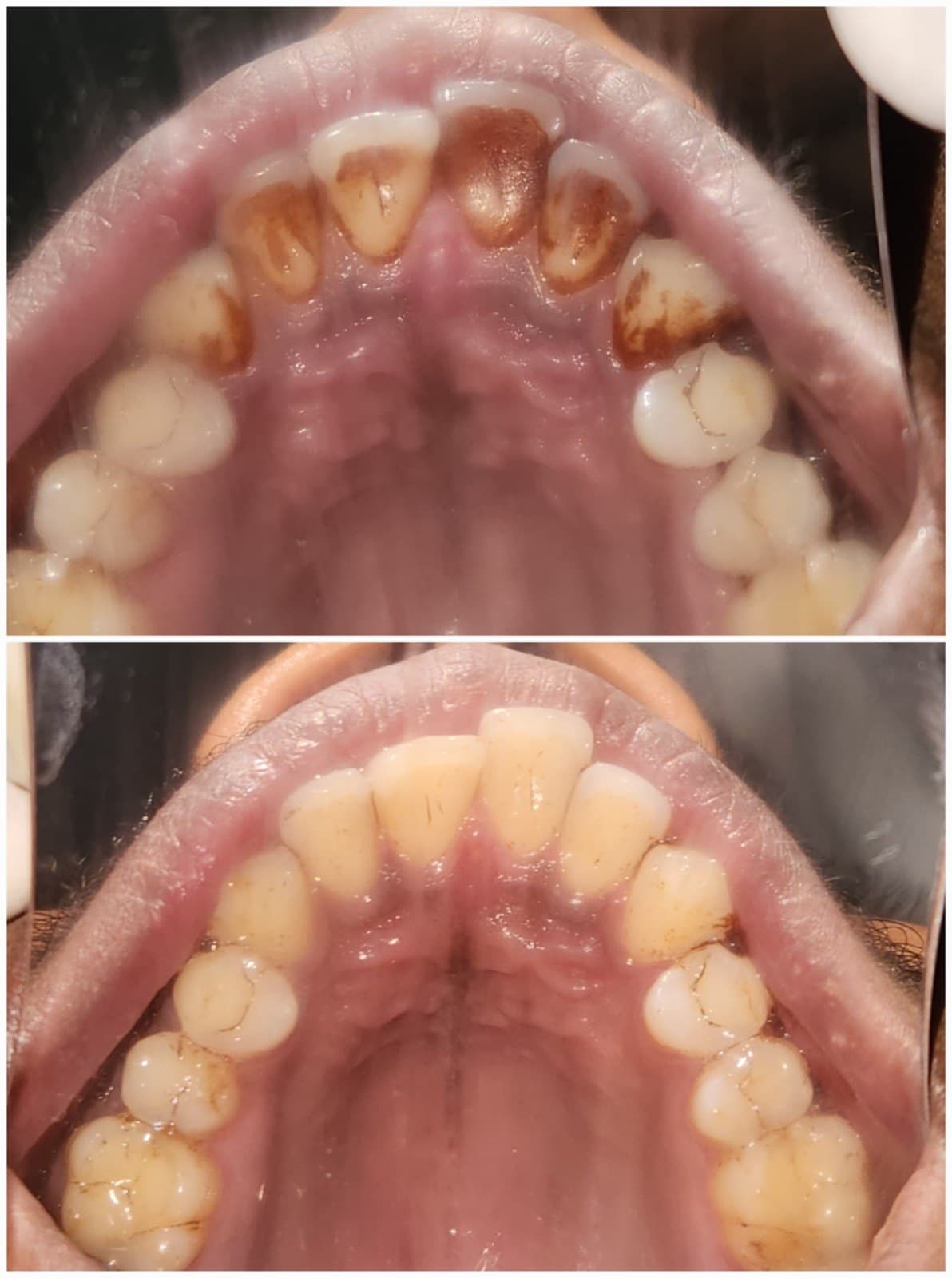 Scaling & cleaning