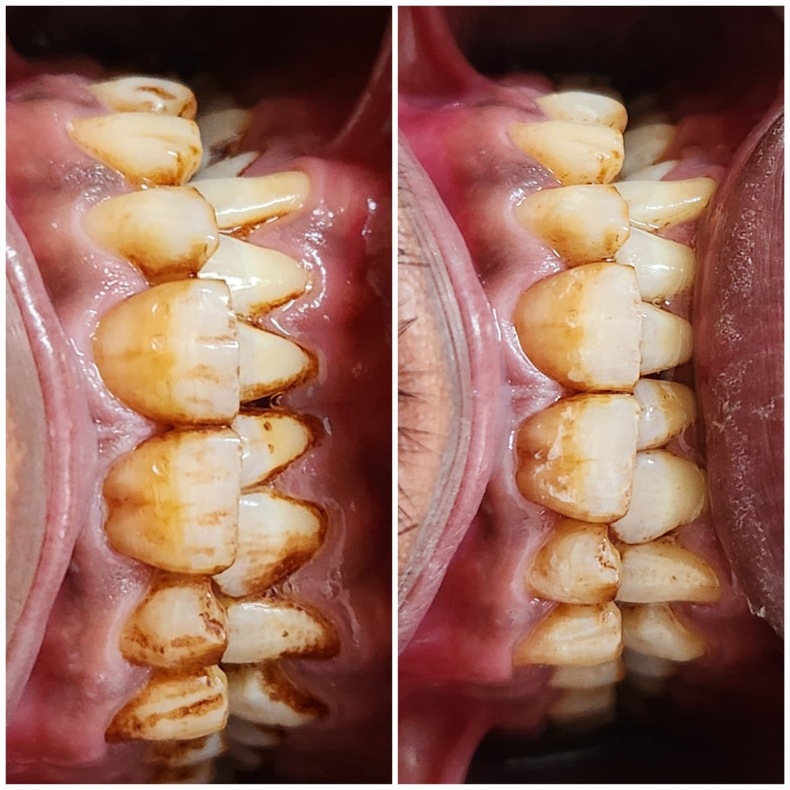 Scaling & cleaning
