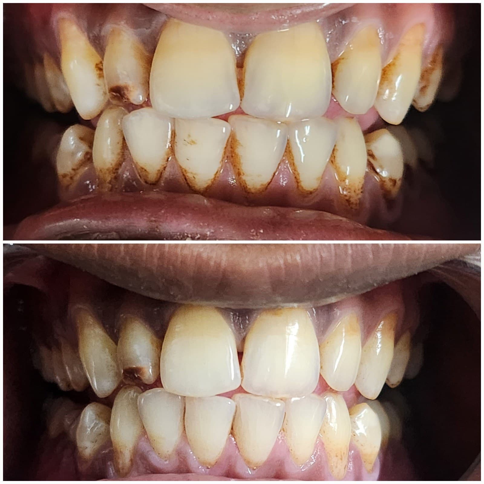 Scaling & cleaning