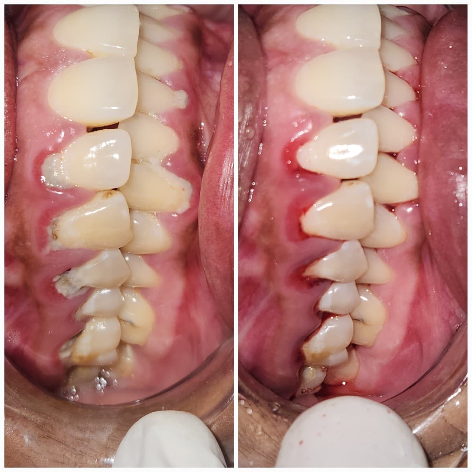 Scaling & cleaning