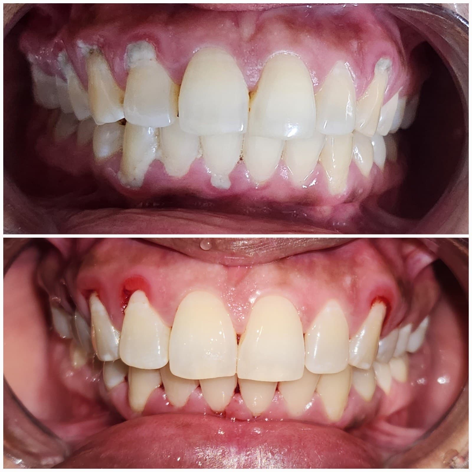 Scaling & cleaning