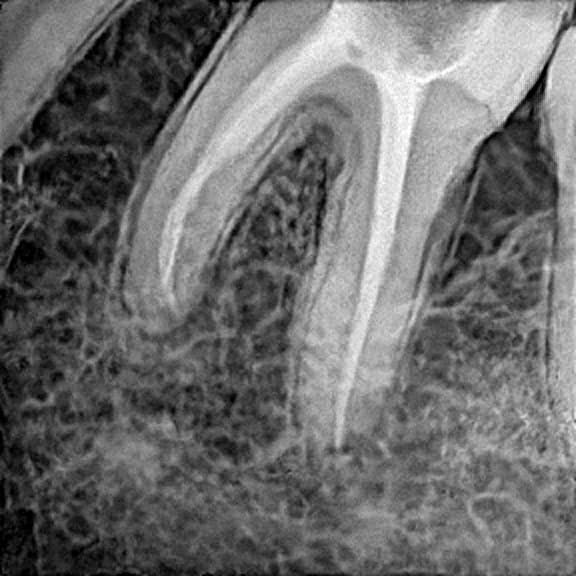 Root canal treatment