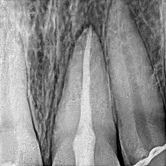 Root canal treatment