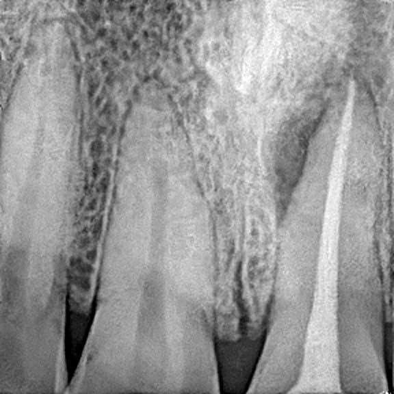 Root canal treatment