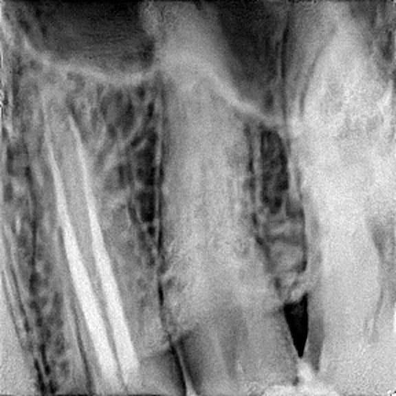 Root canal treatment