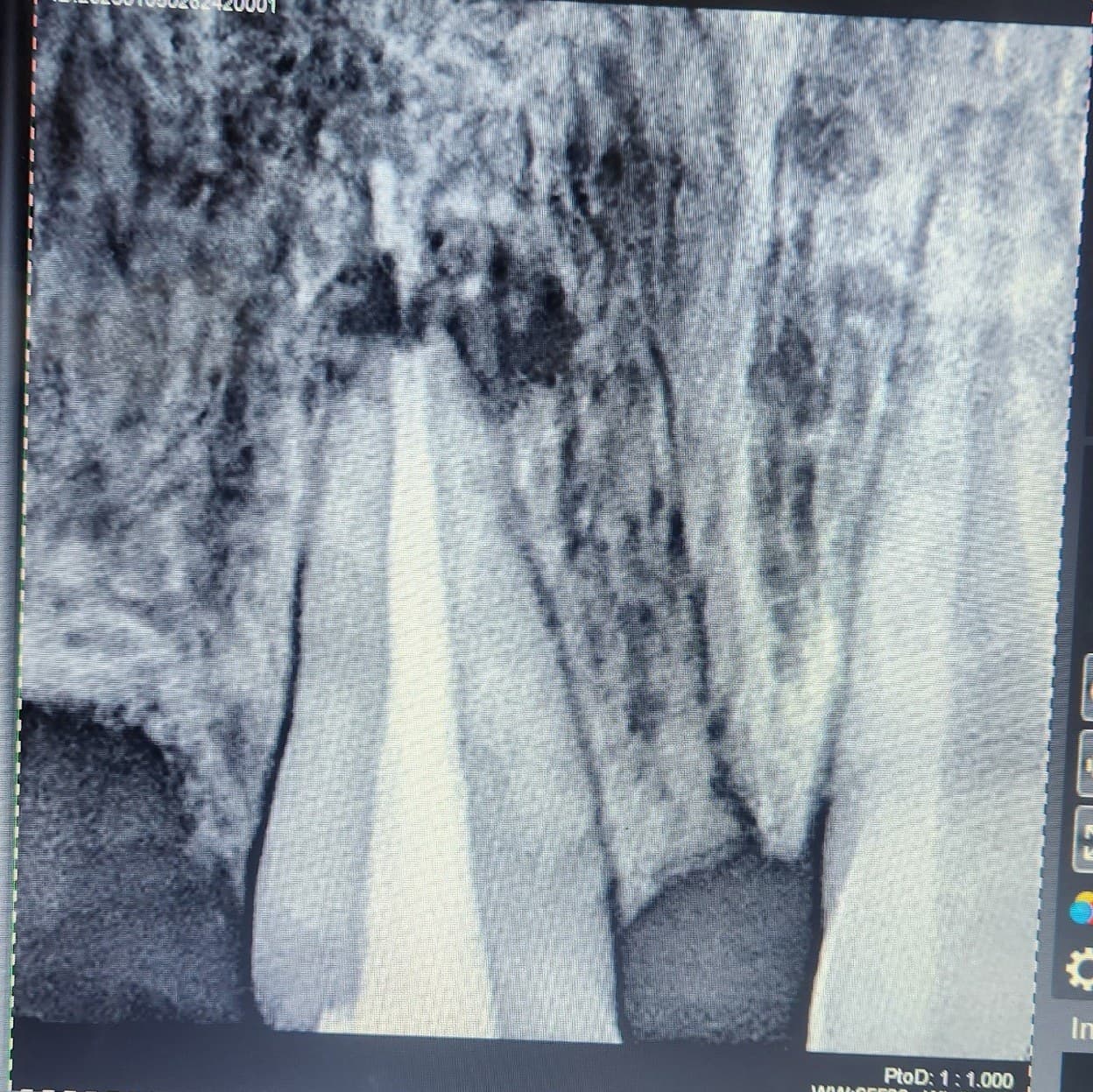 Root canal treatment