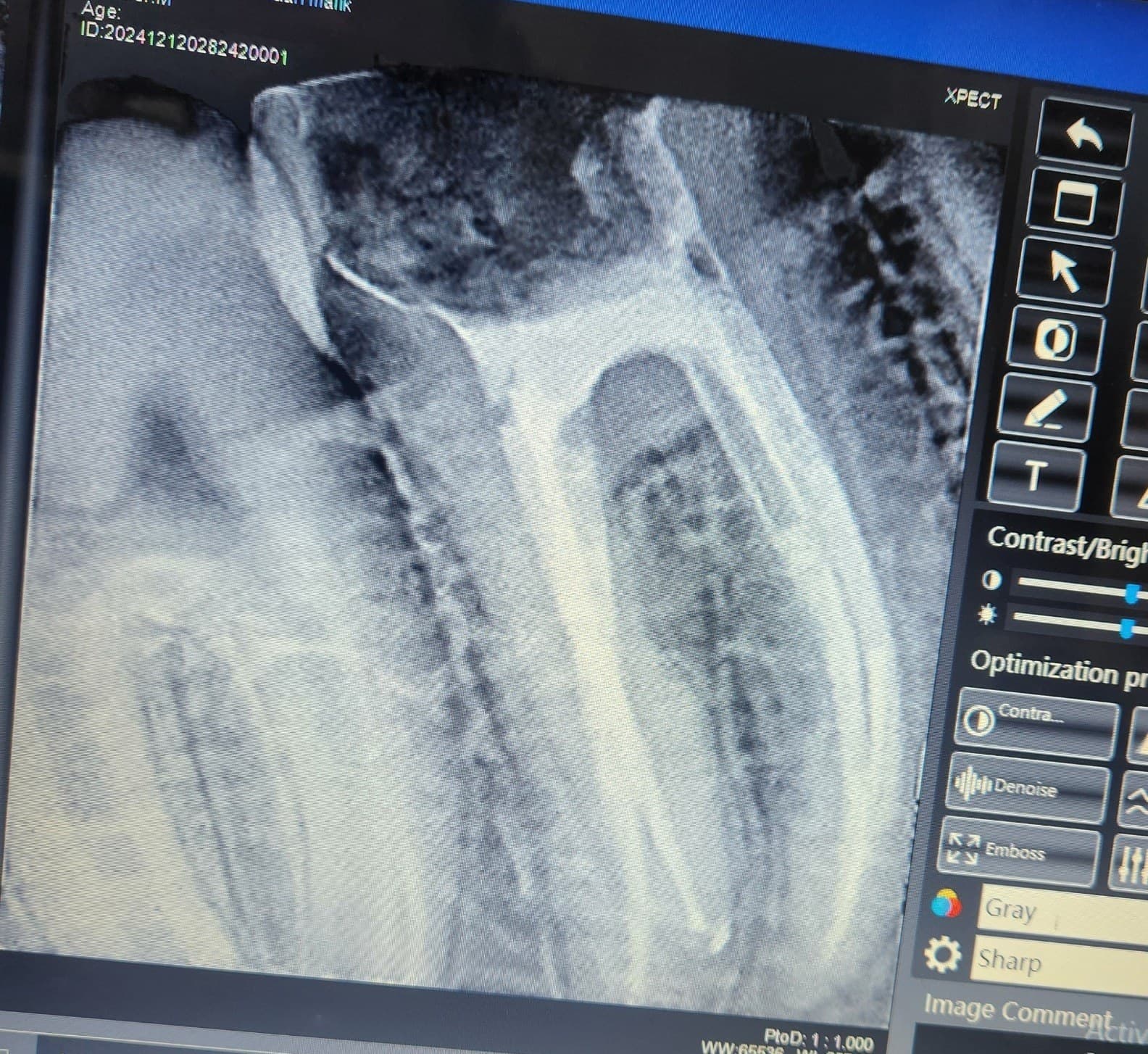 Root canal treatment