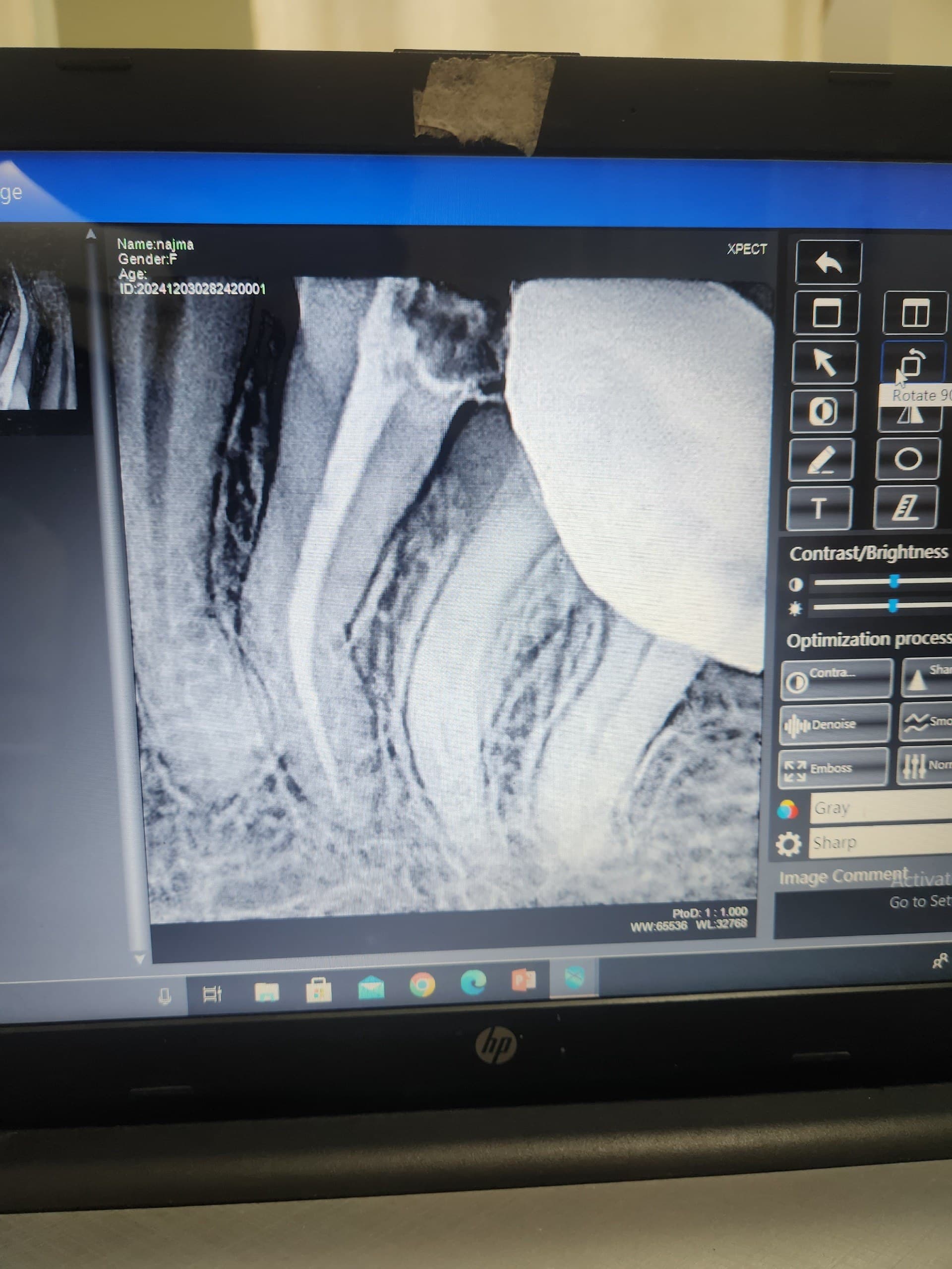 Root canal treatment