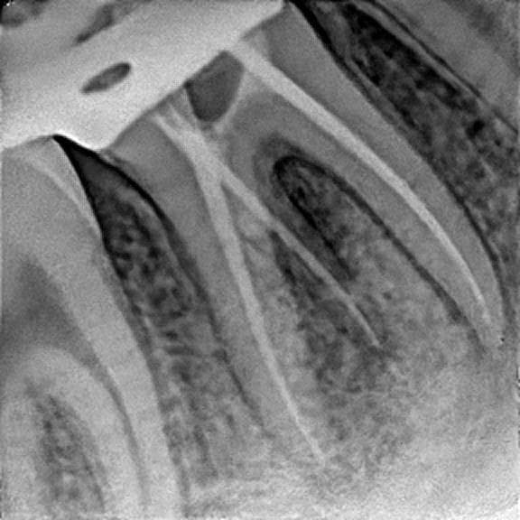 Root canal treatment