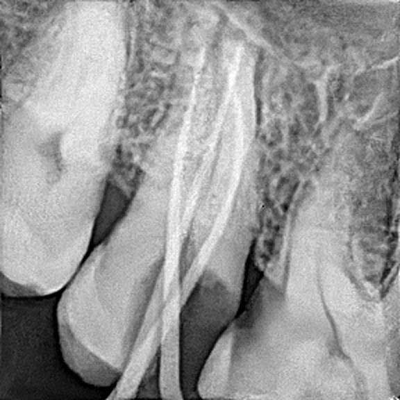 Root canal treatment