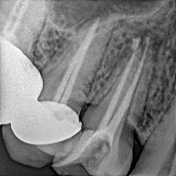 Root canal treatment