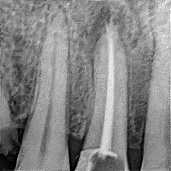 Root canal treatment