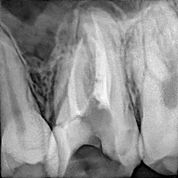 Root canal treatment
