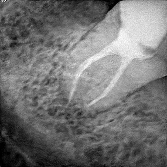 Root canal treatment