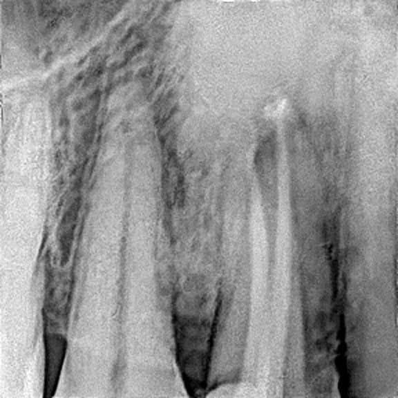 Root canal treatment