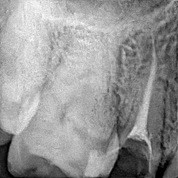 Root canal treatment